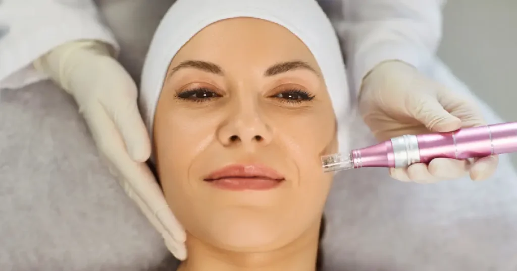 Women Receiving Microneedling Treatments in El Cajon, CA