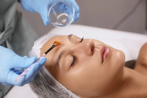 Chemical-Peels