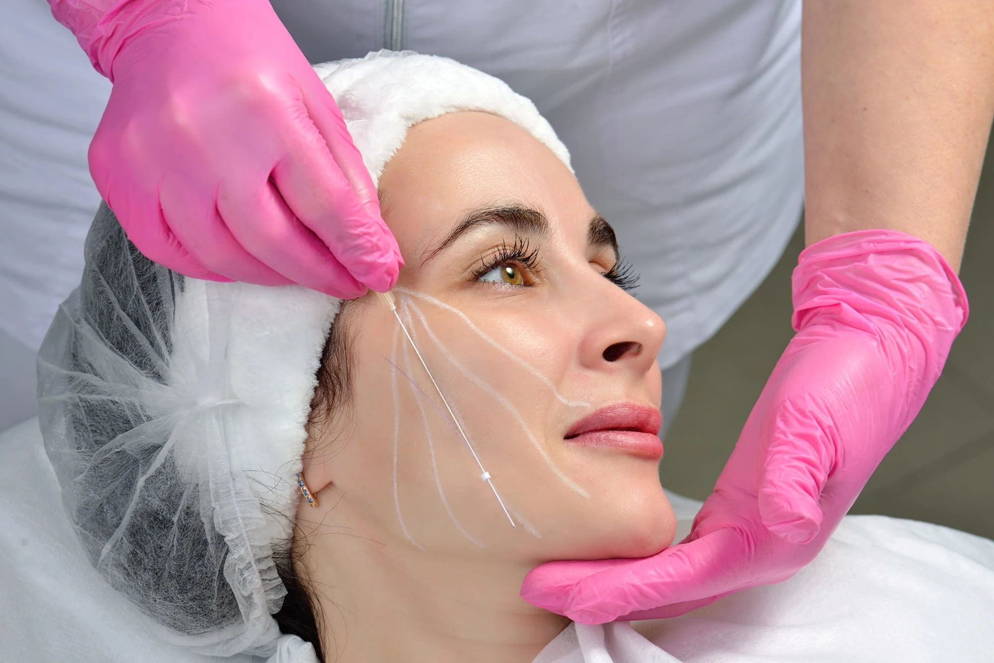 What to Expect Before, During, and After PDO Thread Treatment